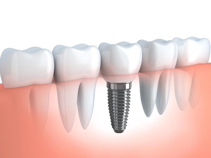 Dental Implants Prescott, WI