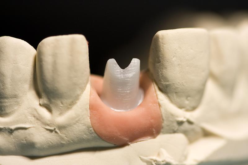 Implant Restoration Prescott, WI