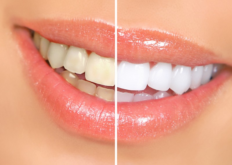 Teeth Whitening  Prescott, WI 
